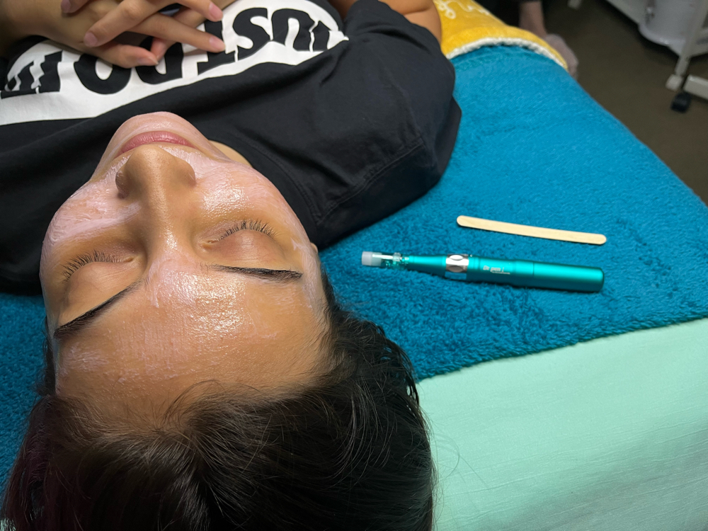 Microneedling