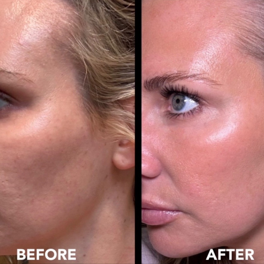 THE SKIN RESET | MICRONEEDLING at LEXTHETICS | Powered by Smiley Aesthetics & Dr. Katrina Briggs, MD in Columbus, OH