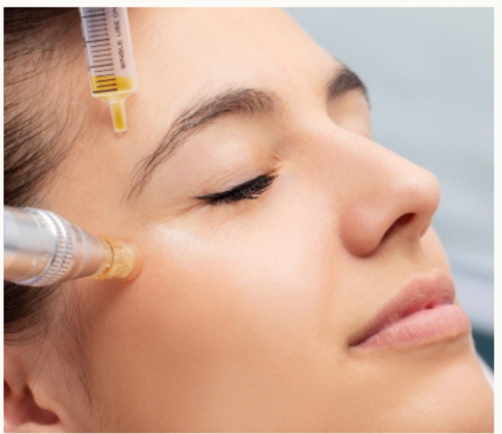 Microneedling with PRP