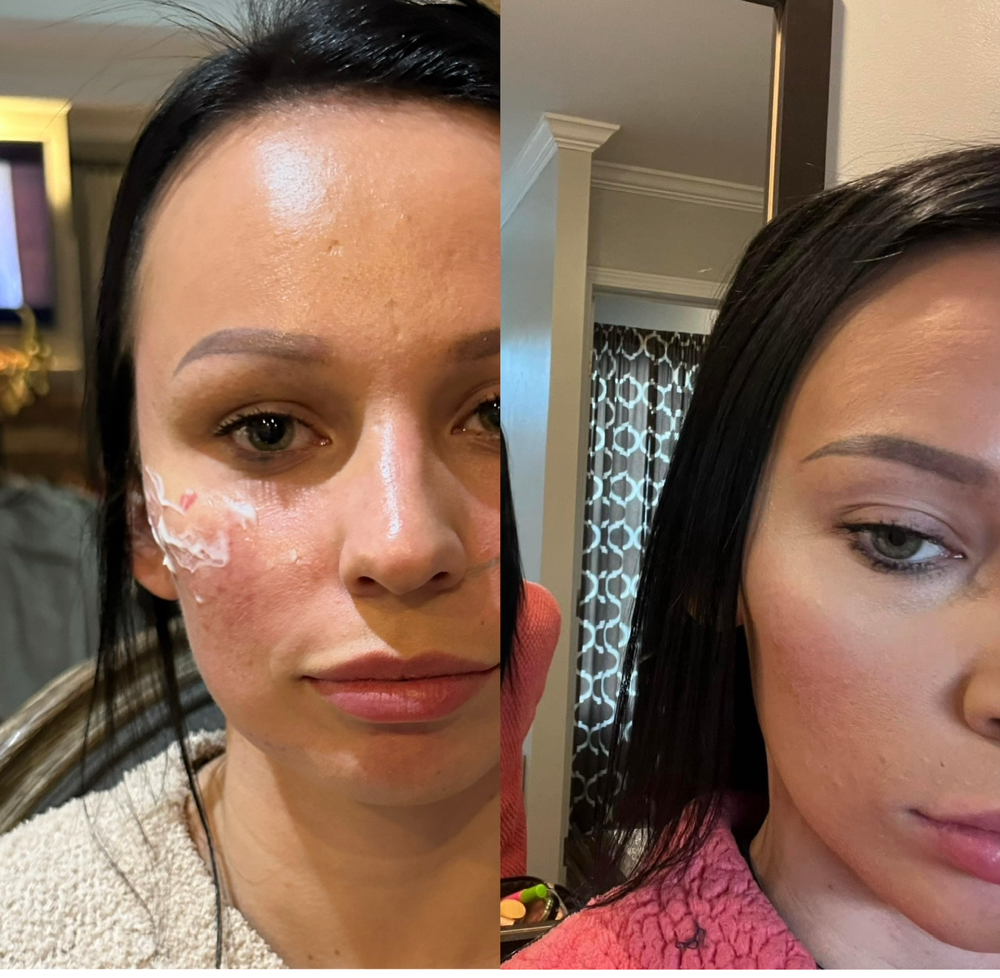 Cheek/Chin/Jawline filler at Candice Stacy in Gilbert, WV