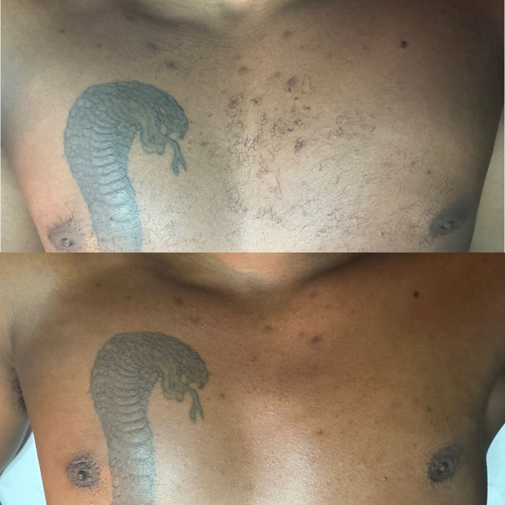 CHEST (M)