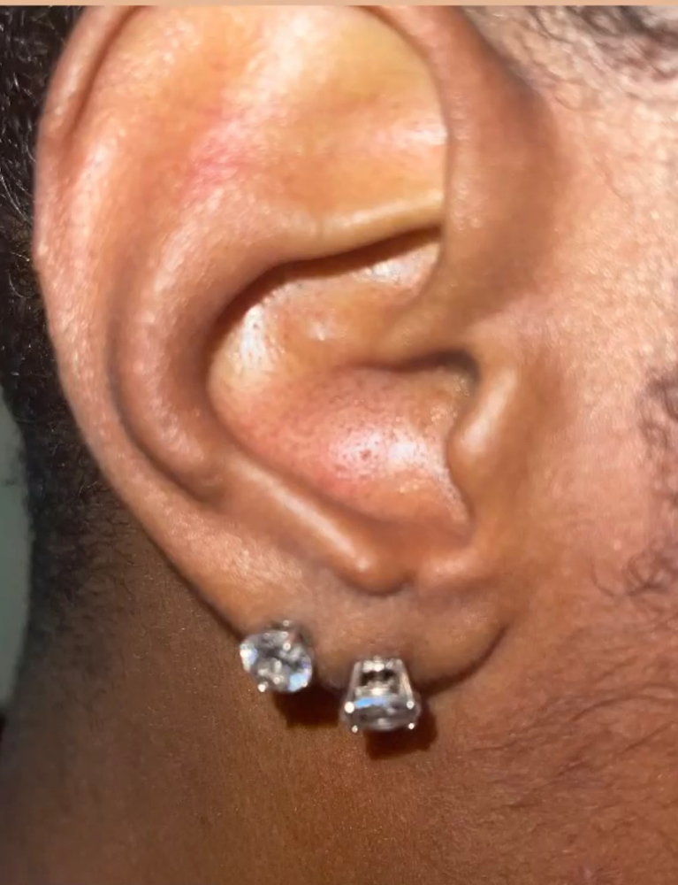 Ear Treatment Add on