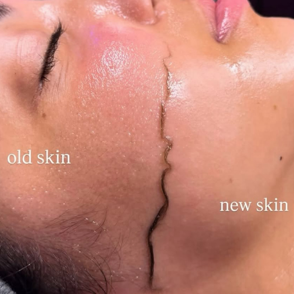 Dermaplane at Kenia Esthetics in Palm Desert, CA