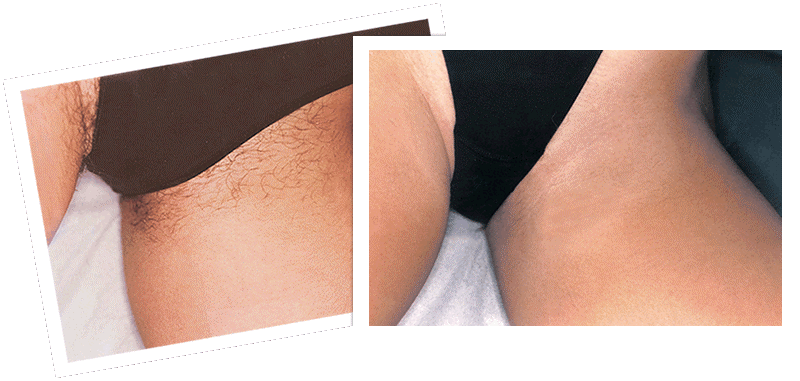 Bikini Hair Removal at Yulee Mac Aesthetics in Tontitown, AR