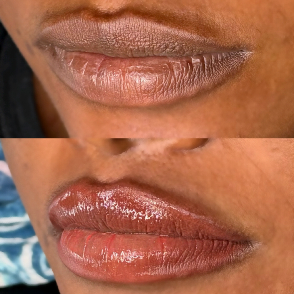Dark Lip Neutralization at Alignd Faces in Lakeworth, FL