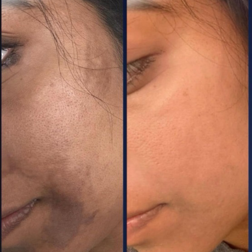 Chemical Peel + Retinol 4% at Lsbeautyspa by Sara in Houston, TX