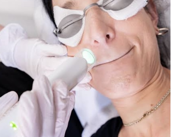 Laser Hair Removal Upper Lip at Skin Concepts in South Hempstead, NY