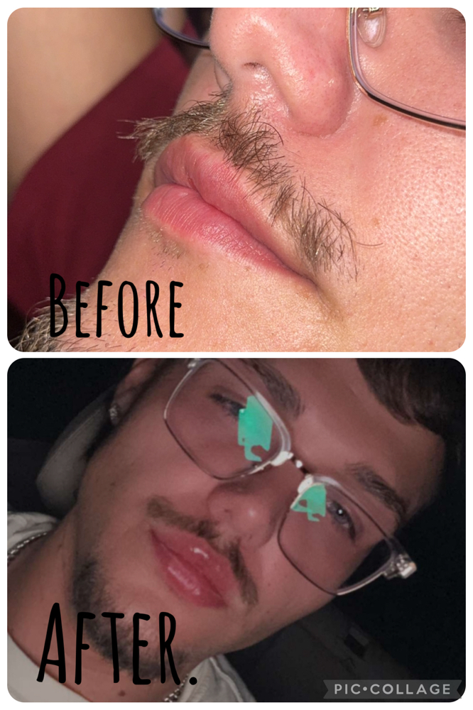 Half Syringe ( Lip Filler )