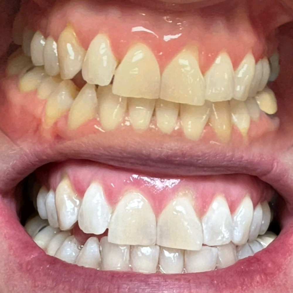 80 Minute Teeth Whitening