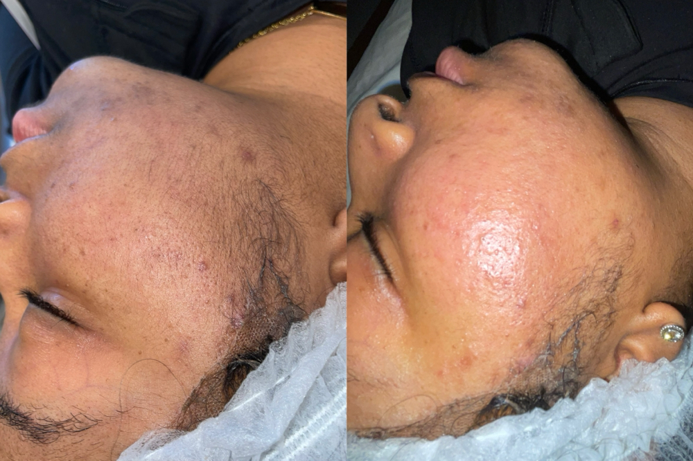 DermaPlan at Elegant Beautie in Birmingham, AL