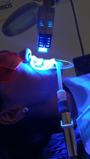 Teeth Whitening at PURE GLOW DUO in cleveland, TX