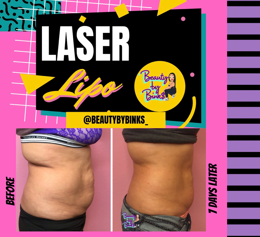 1 Laser Lipo Session