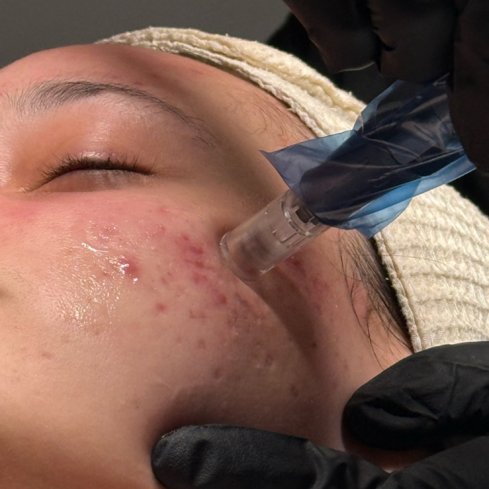 Advanced Treatment Consultation at The Beauty Well in Hillsborough, NC