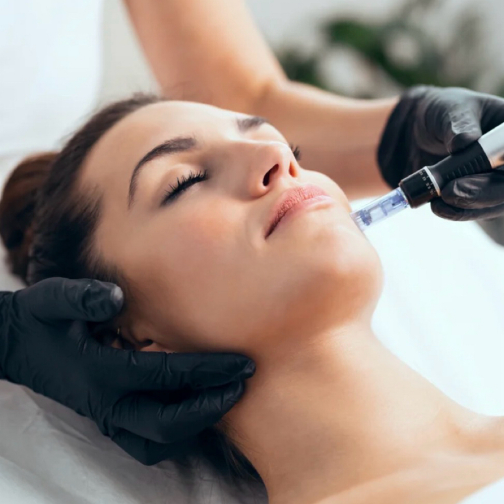 Microneedling at BEAUTY SPOT in Jacksonville, FL
