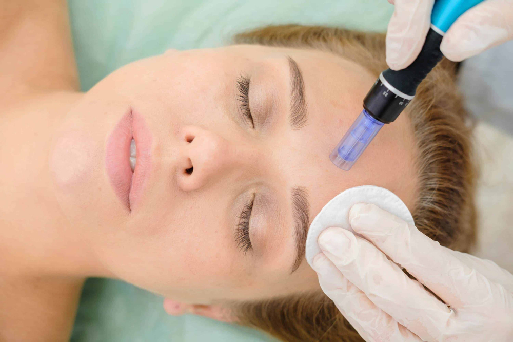 Microneedling Facial