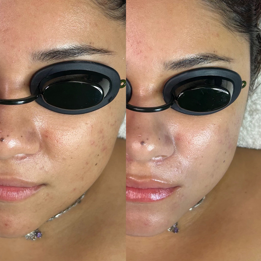Acne Peel