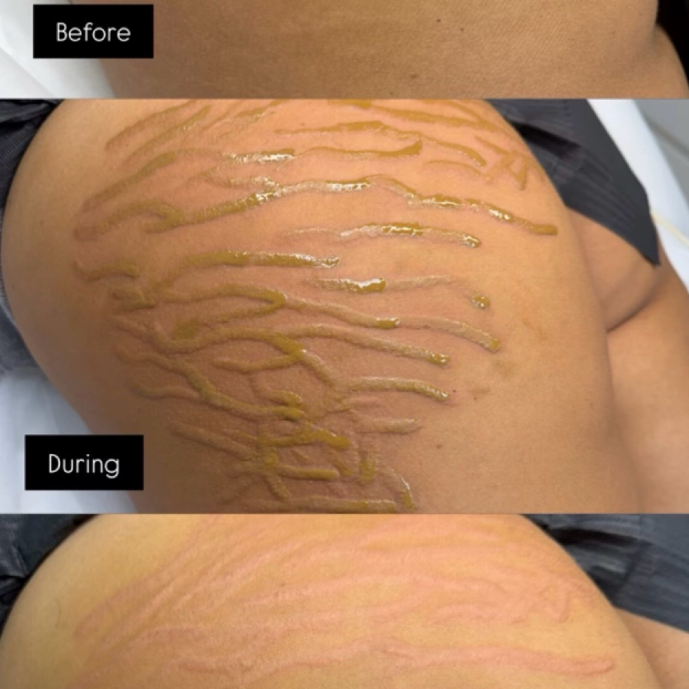 Treatments Per Body Area & Sessions at Faces by Anissa in Dunwoody, GA