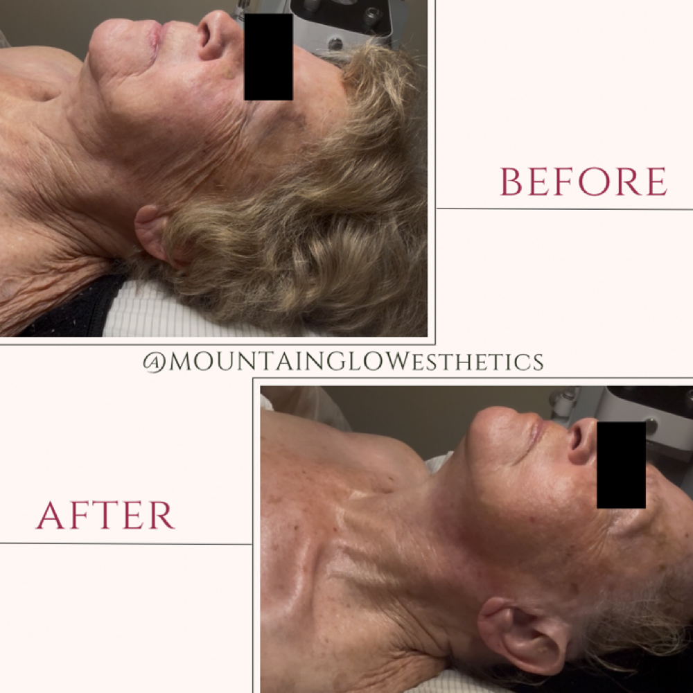 Firming Facial at Mountain Glow Esthetics in Newland, NC