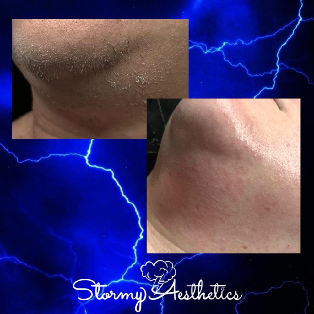Chin Wax at Stormy Aesthetics in Clearwater, FL