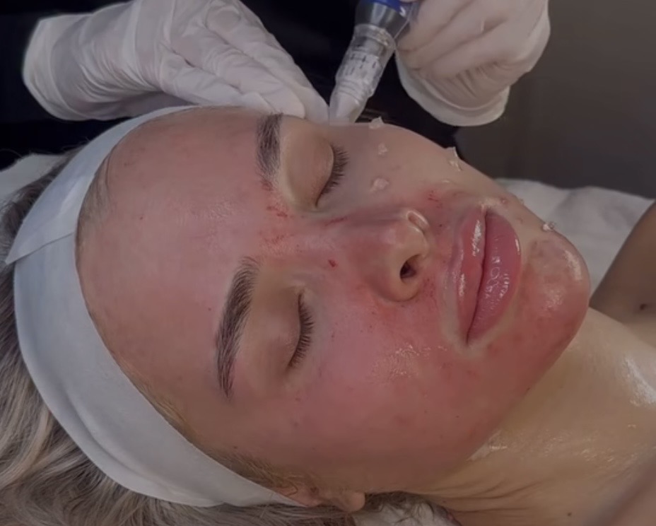Microneedling/CIT at Skin & Beauty Aesthetics Studio in New York, NY