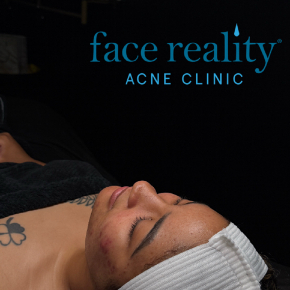 NEW CLIENT ACNE CONSULT + TREATMENT at Lashes+corrective skincare+waxing+brows in Temecula, CA