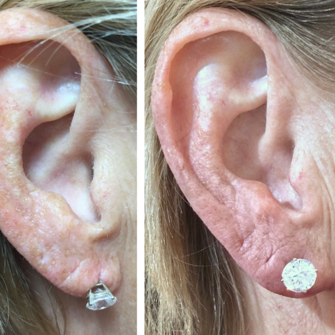 Earlobe Filler - Volume Restoration at BLUSH Aesthetics LLC in Laredo, TX