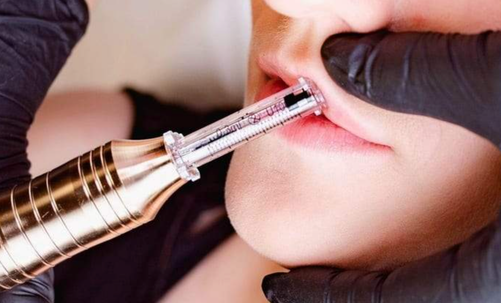 Lip Volume Enhancement 1ml
