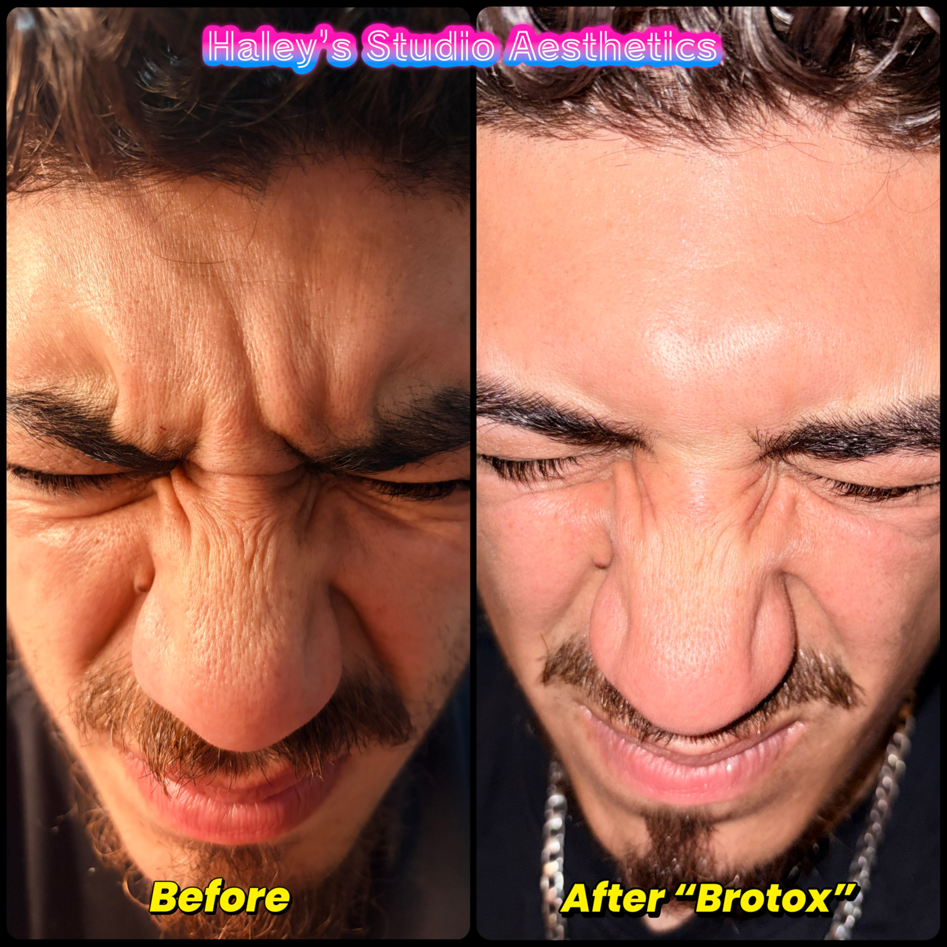 Brotox- Tox for Men at Haley's Studio Aesthetics in Fort Worth, TX