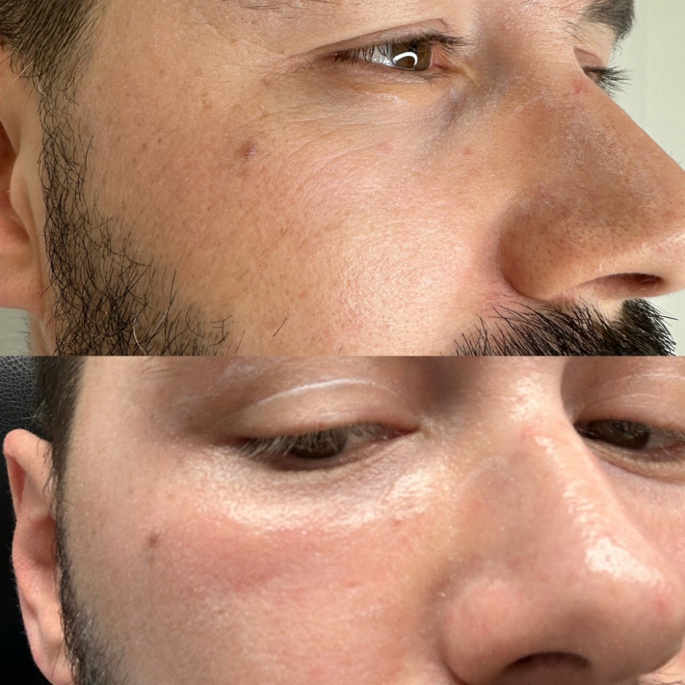 Lower Eyelids and Crows Feet Combo at Magnolia Plasma Fibroblasting By Mitra in Frisco, TX