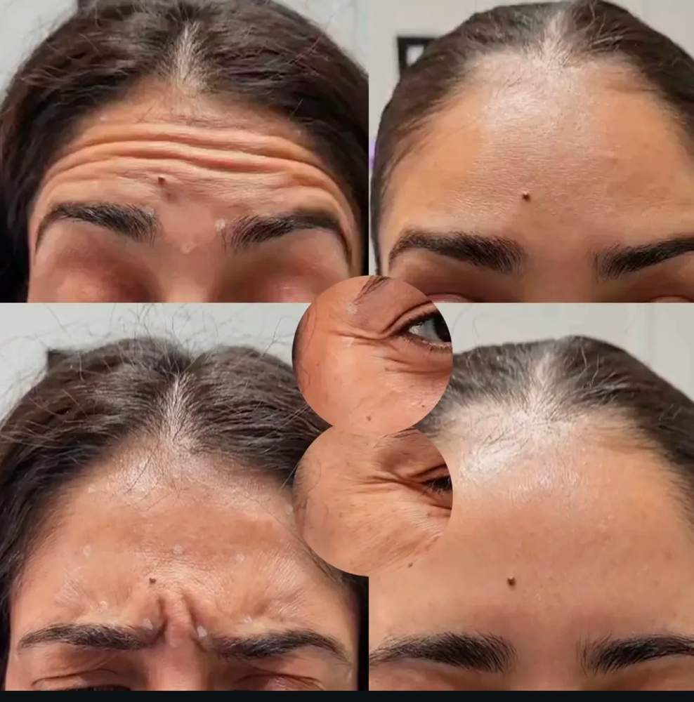 40 Units of Botox