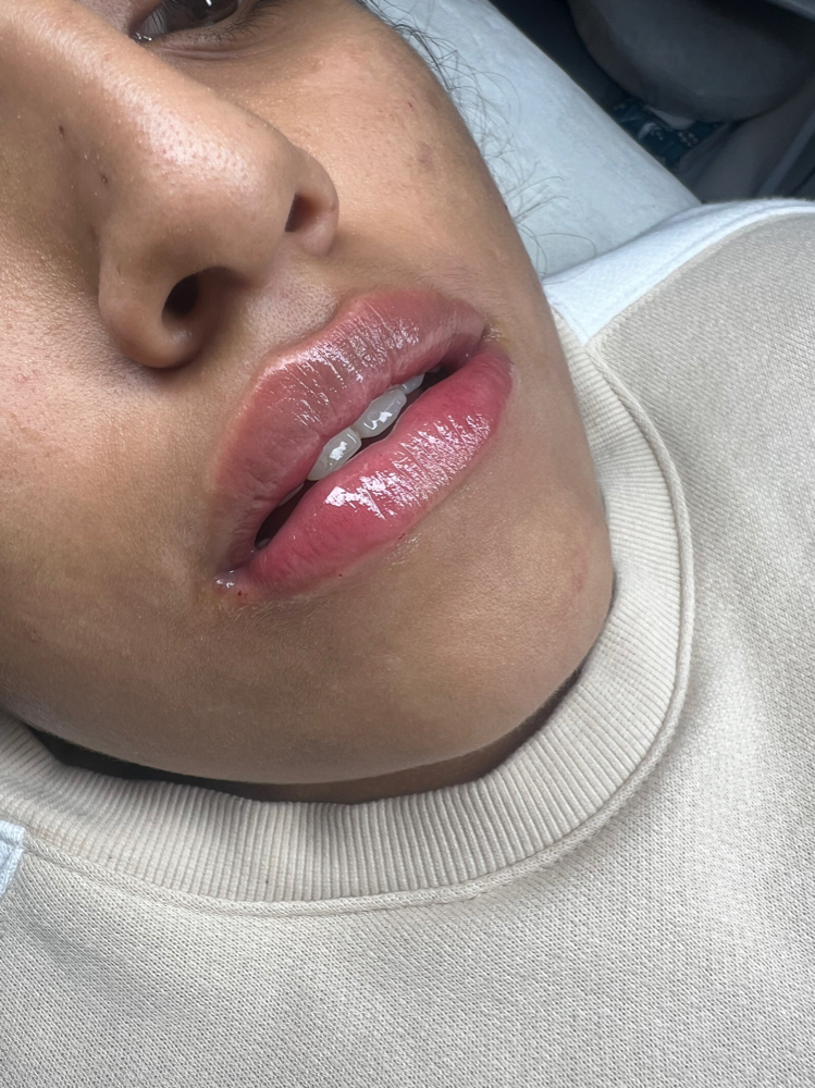 Lips Filler