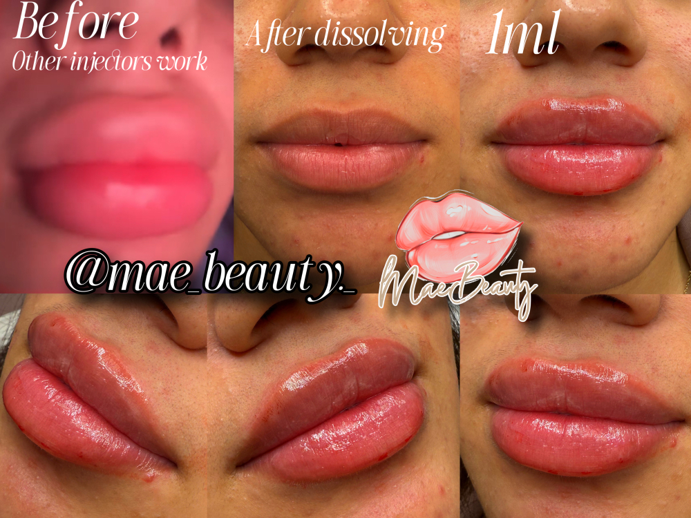 Lip Injections at MaeBeauty in Mesquite, TX