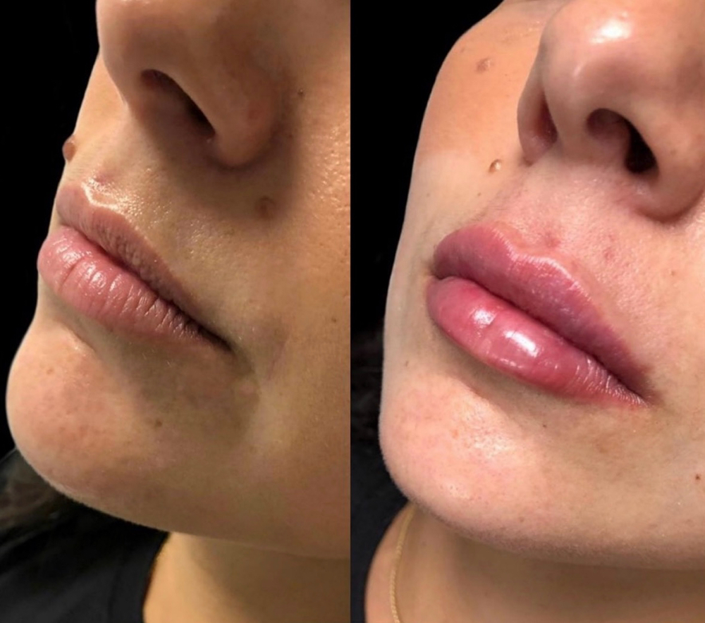 Half Syringe(0.5ML) Lip Filler at Perfection Injections in Euless, TX