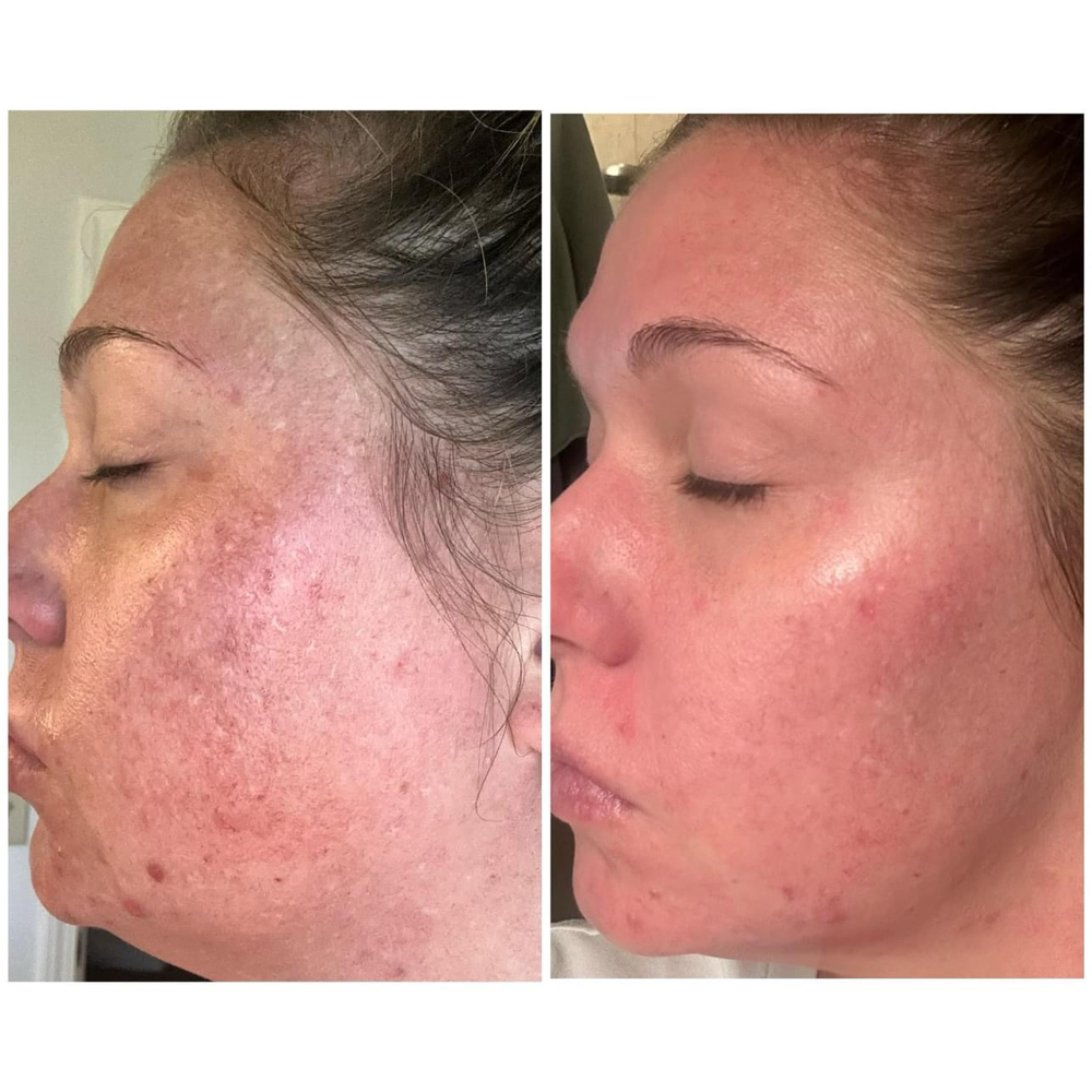 Microdernabrasion+PEEL