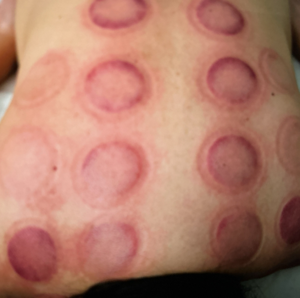 60 mins Cupping at Valencia Muscular Therapy in San Antonio, TX