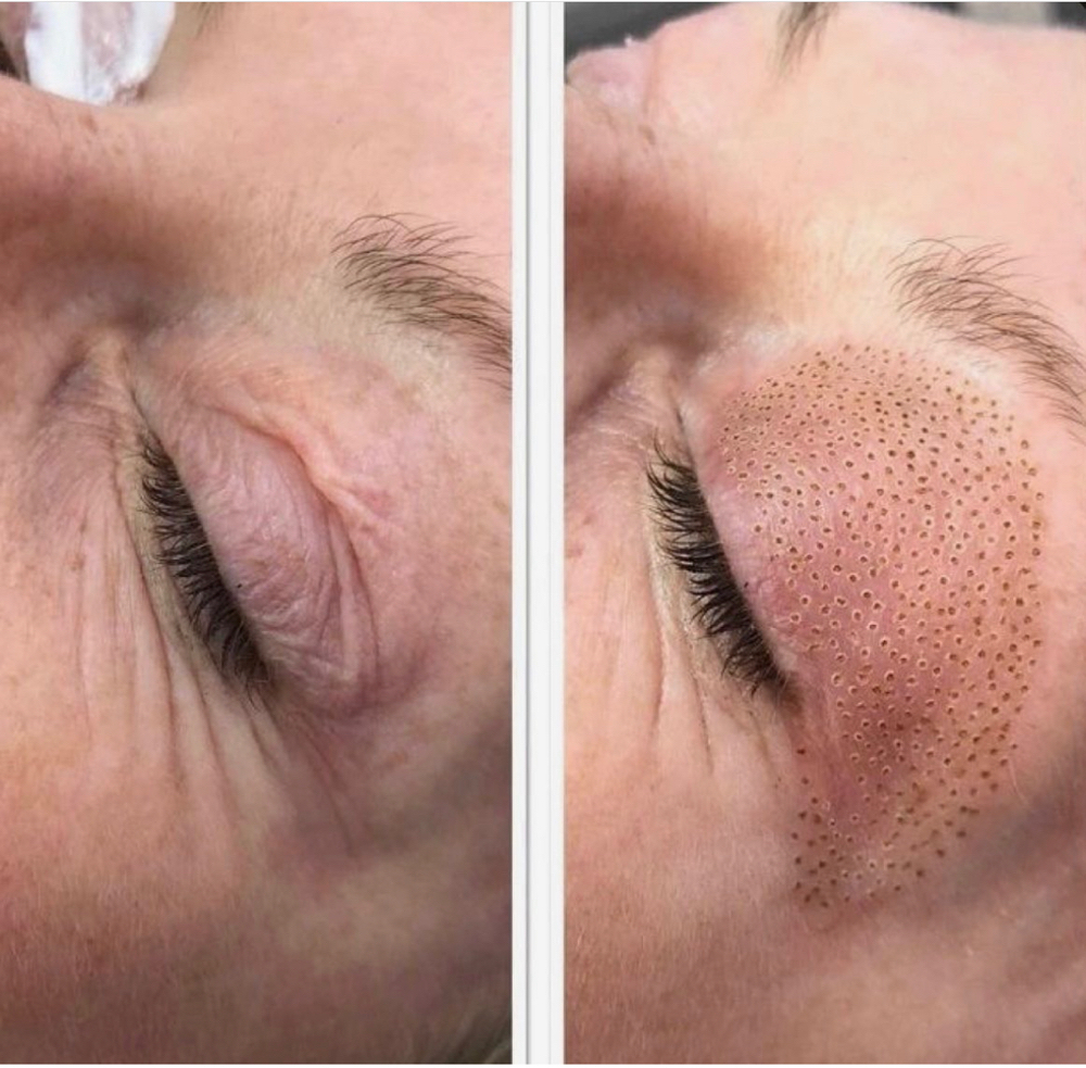 Upper Eye Fibroblast Under Eye FREE