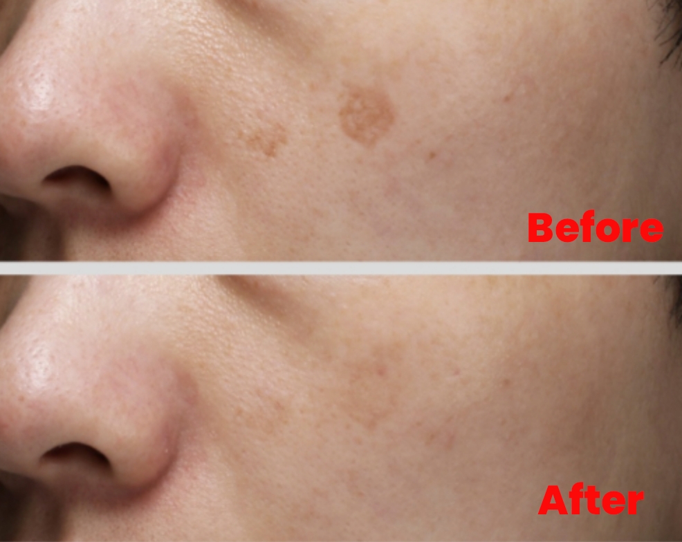 Customized Chemical Peel