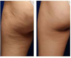 Cryo ~ Cellulite