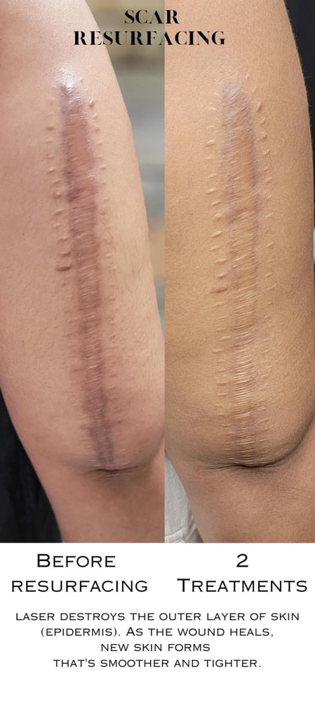 Scar Rejuvenation