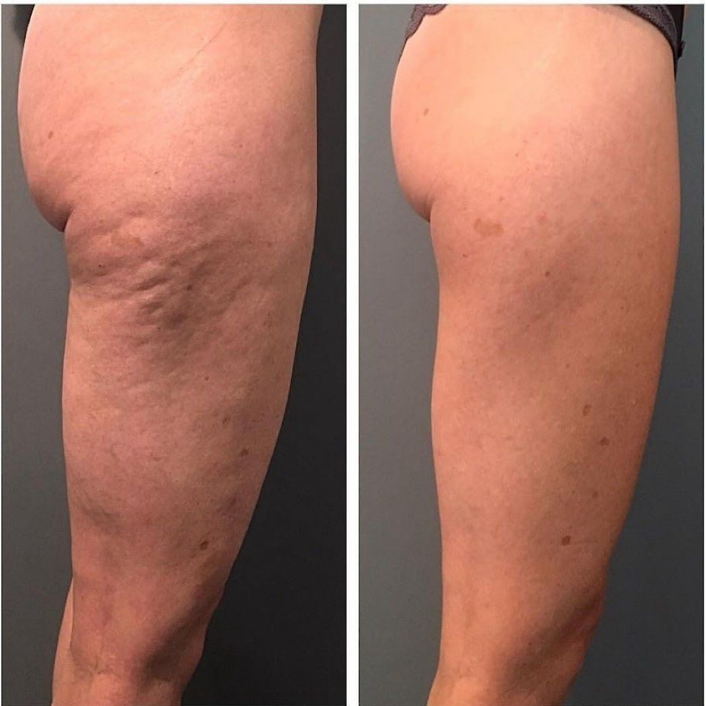 ANTI -CELLULITE BODY CONTOURING at Body Wax & Sugaring Studio in Boca Raton, FL