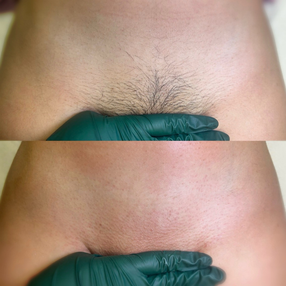 Brazilian + Vajacial at Waxed By Chloe in Smyrna, TN