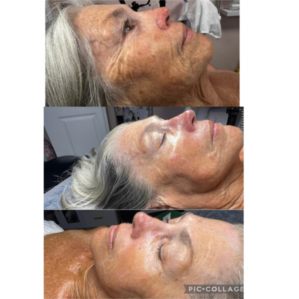 Lift & Firm “Beyond Botox” Facial at Bottumzup Health and Wellness,LLC in Davenport, FL