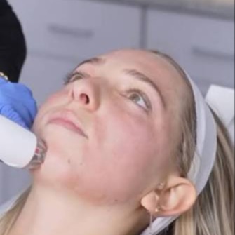 Candela RF Sublative & Sublime at Illumina Aesthetics and Laser in Palm Beach Gardens, FL