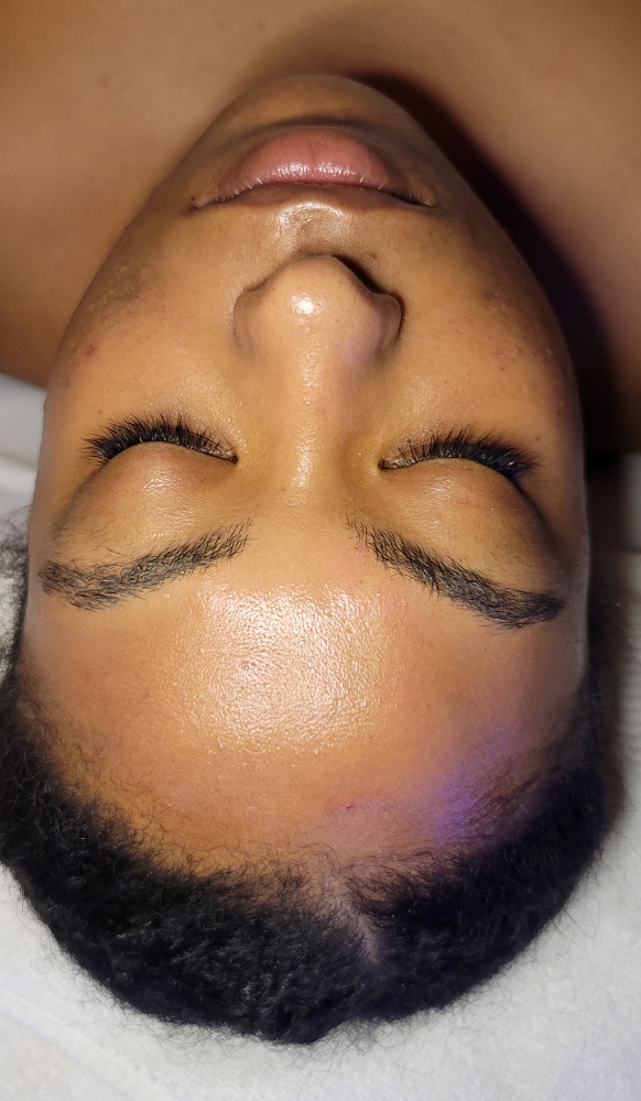 Dermaplaning