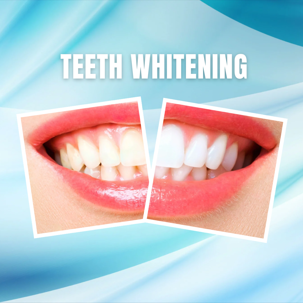 30 Min LED Teeth Whitening