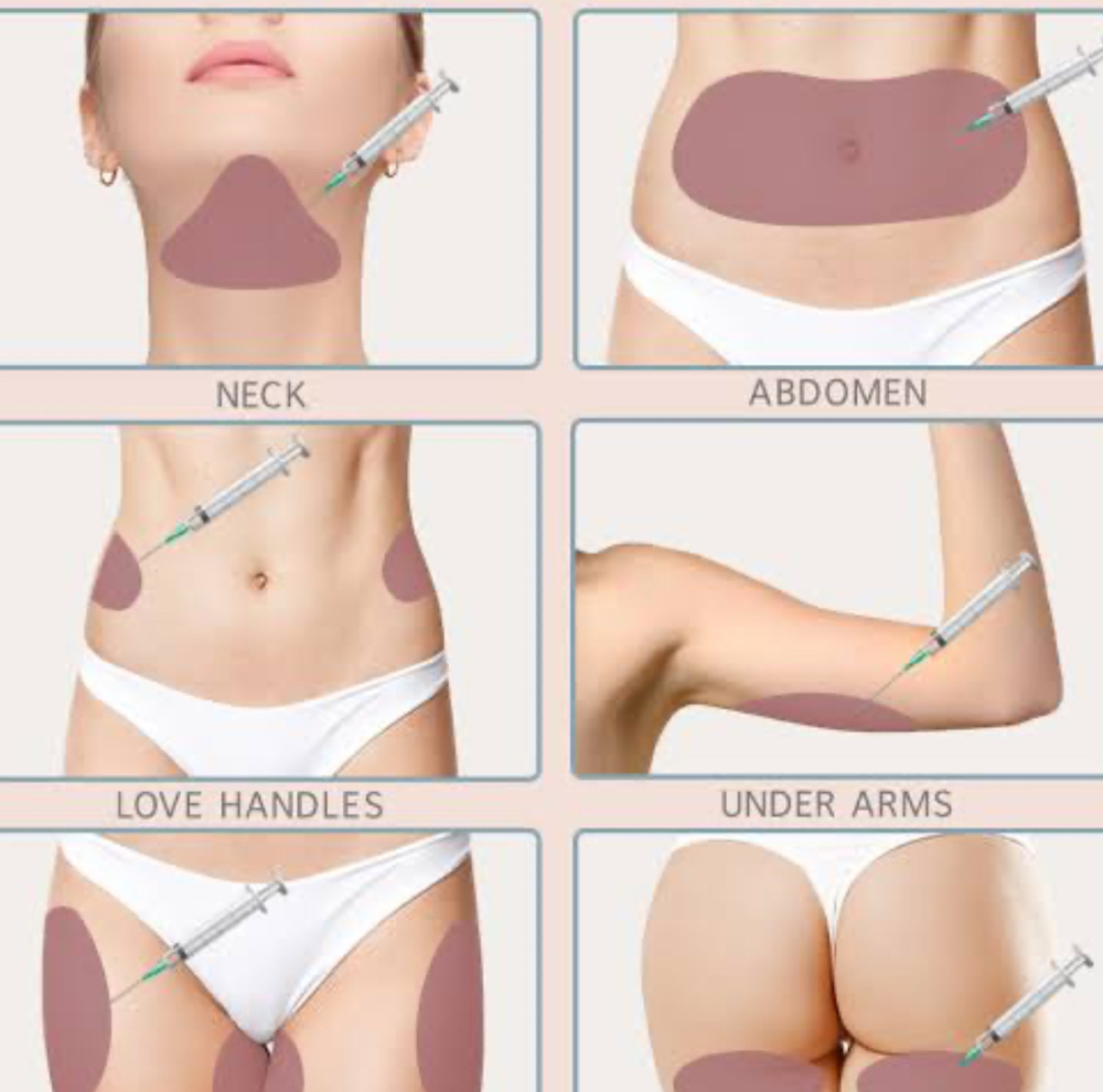 Fat Dissolving Injection (lrg area)