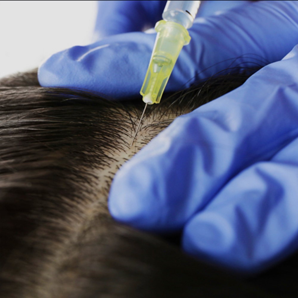 PRP Hair restoration Series of  3 at Reviva Wellness in Lake Ozark, MO