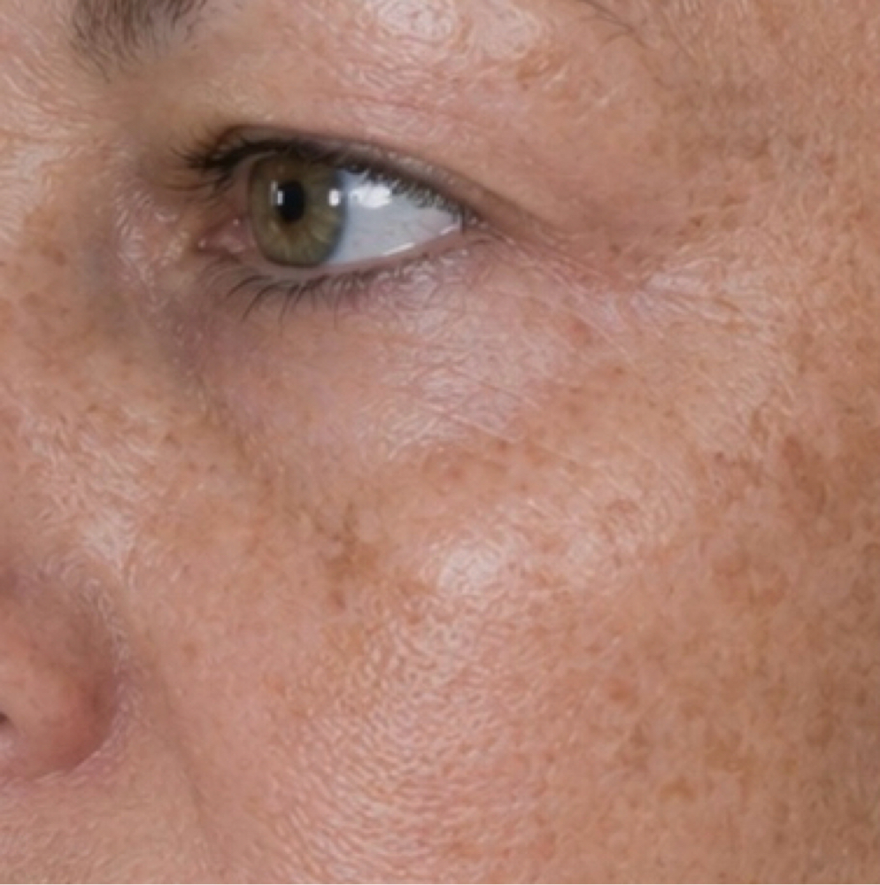 Lumen Peel ,age Spots,sun Damage at Alchemy Wellness Studio in Torrington, CT
