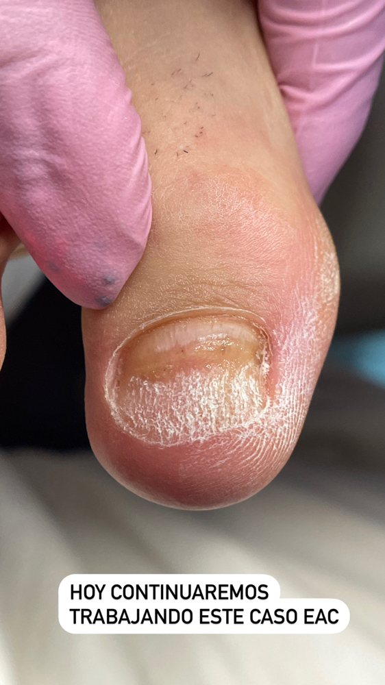 Primer Tratamiento IBX con Uñero