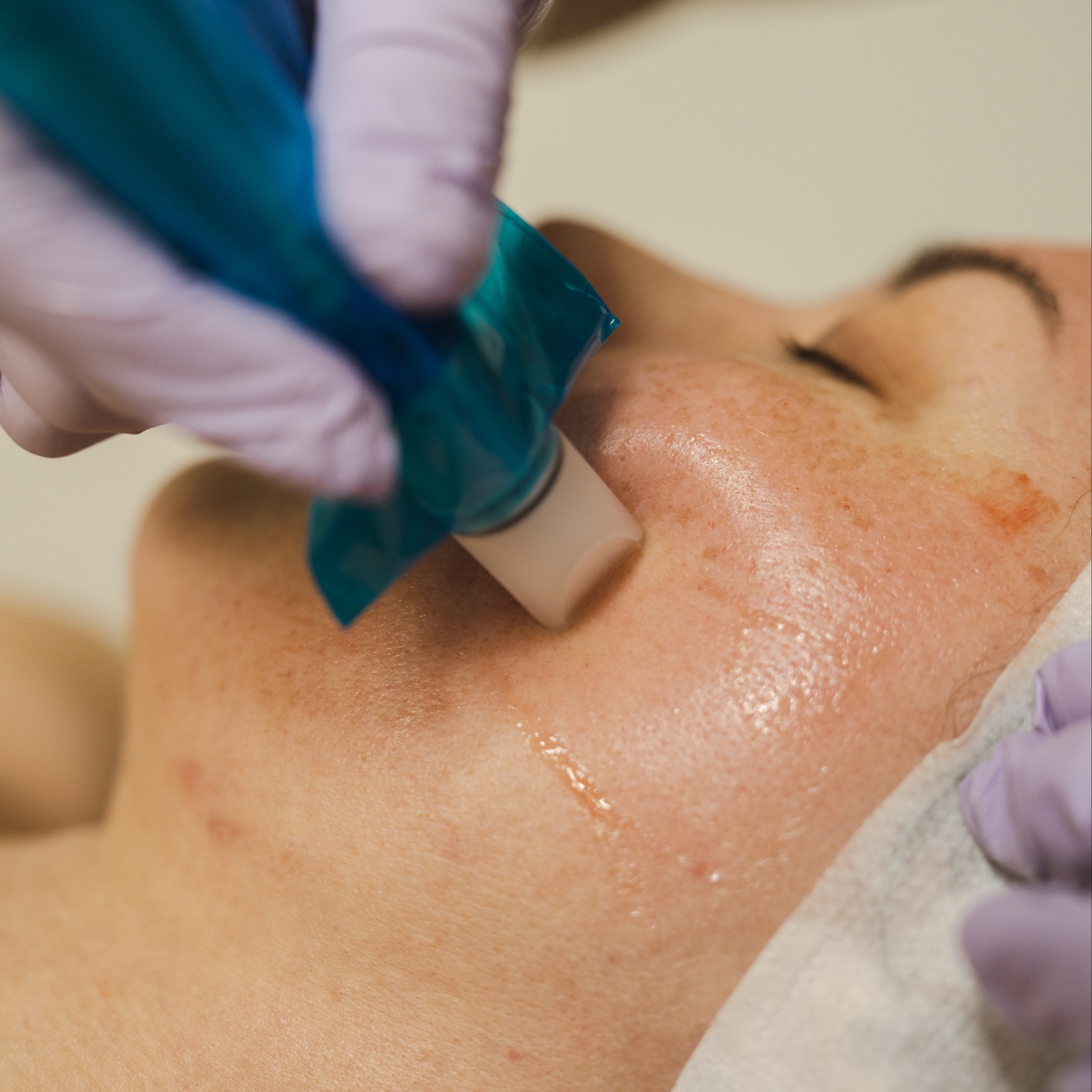 Microchanelling Face - Series of 6 at Alina Buzinsky in West Dundee, IL